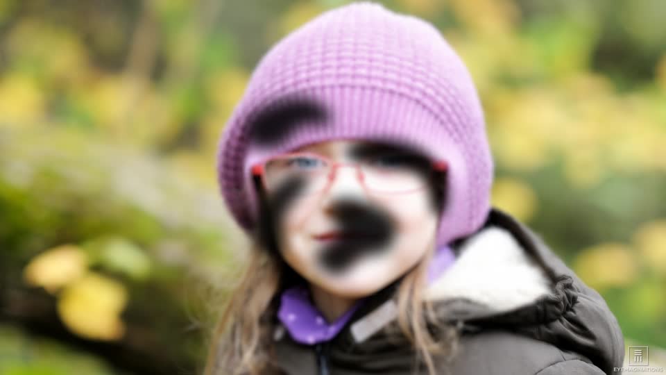 Image of a young girl with black spots over the image to simulate patchy or blurred vision